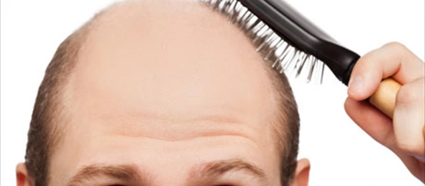 Aυτές οι συνήθειες δημιουργούν φαλάκρα!